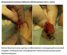 Окклюзия сосудов с помощью клея «Сульфакрилат».