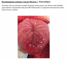 Удаление опухоли мочевого пузыря.